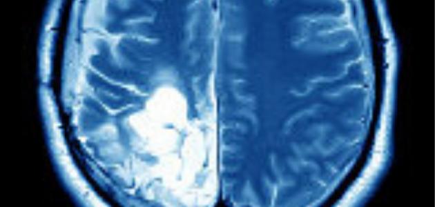 اعراض ورم الدماغ