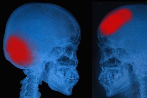 اكتشاف السكتة الدماغية