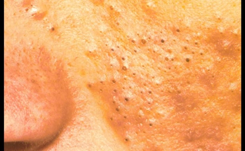 d8a7d984d8aad8aed984d8b5-d985d986-d8a7d984d8b1d8a4d988d8b3-d8a7d984d8b3d988d8afd8a7d8a1-825x510-2 التخلص من الرؤوس السوداء