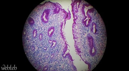 d8a7d984d8aad987d8a7d8a820d8a7d984d985d8b9d8afd8a9 التهاب المعدة المزمن