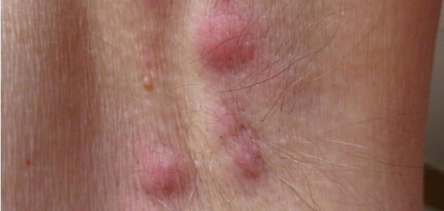 التهاب الغدد اللمفاوية في الابط