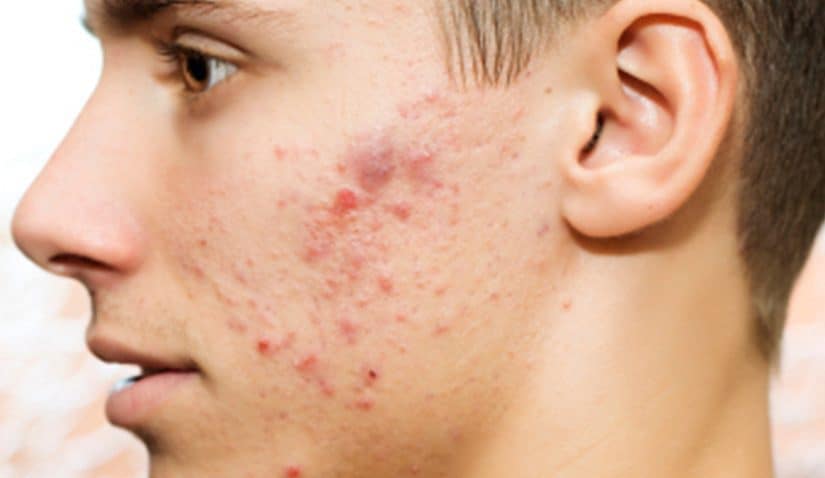 الحجامة وحب الشباب