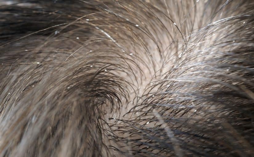 d8a7d984d8aed984-d988d8a7d984d8bad8a7d8b2-d984d8a7d8b2d8a7d984d8a9-d8a7d984d982d985d984-825x510-2 الخل والغاز لازالة القمل