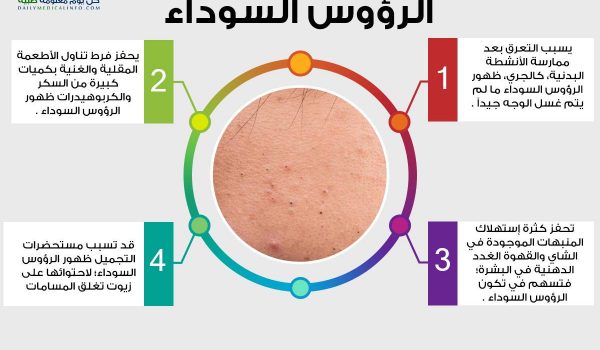 كيفية ازالة الرؤوس السوداء
