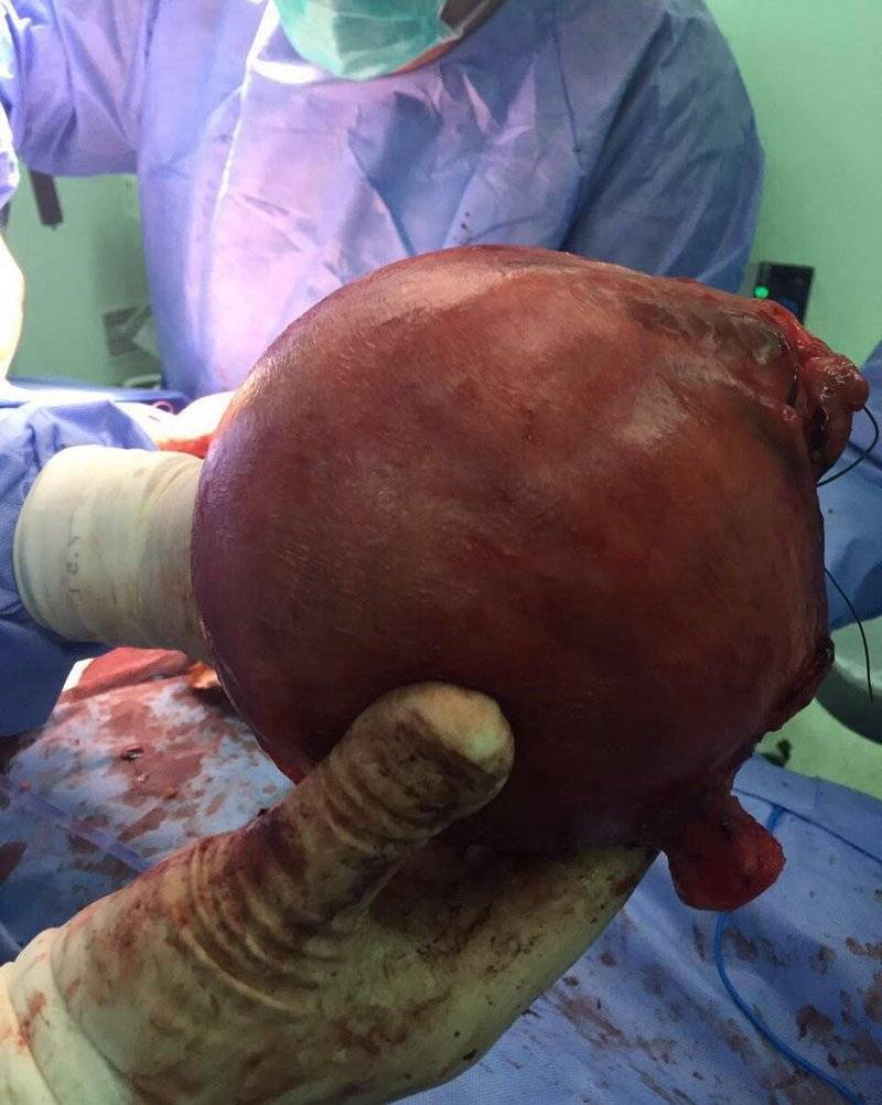 إستئصال الرحم