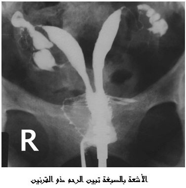 الرحم ذو القرنين1