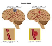 السكتة الدماغية