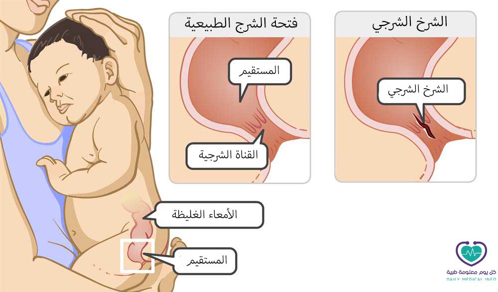 الشرخ الشرجي عند الاطفال