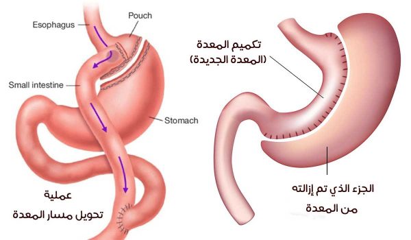 الفرق بين تكميم المعدة وبين تحوير المعدة