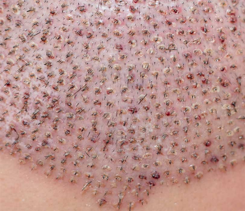 القشور بعد زراعة الشعر