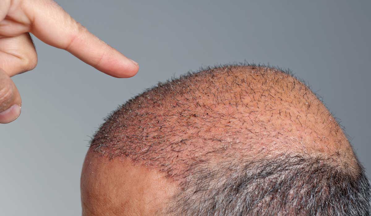 القشور بعد زراعة الشعر