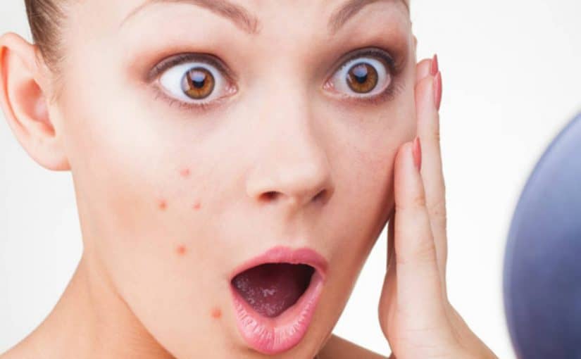 المرهم الاسود لحب الشباب