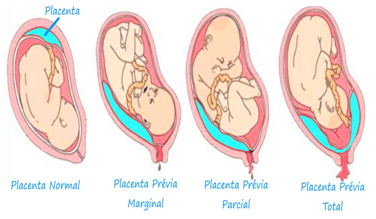 المشيمة المنزاحة