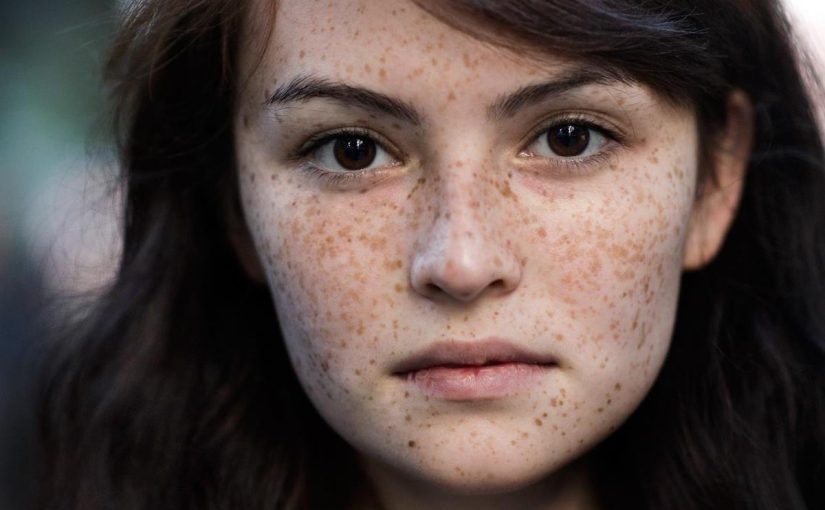 كيف تعالج النمش طبيعيا