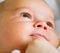 طفل يعاني من اليرقان