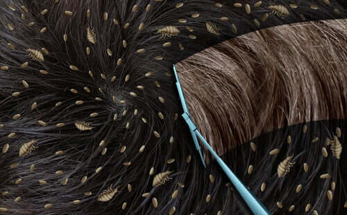 بيض القمل وكيف ينتشر