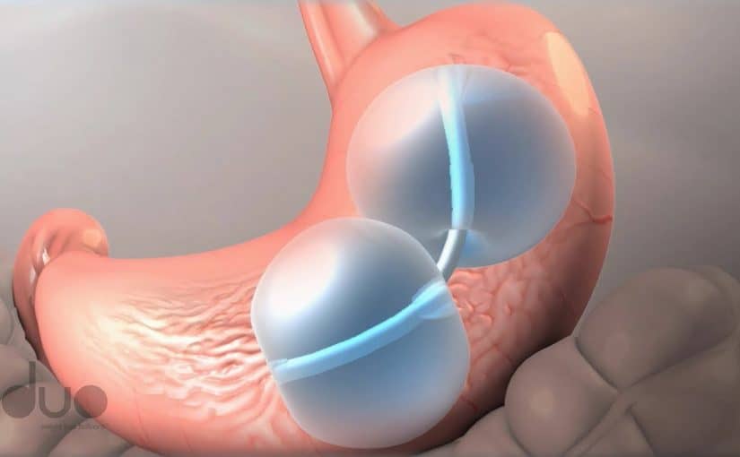 d8a8d8a7d984d988d986-d8a7d984d985d8b9d8afd8a9-825x510-2 خطوات عملية بالون المعدة