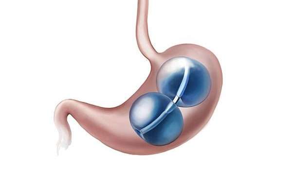 بالون ريشيب