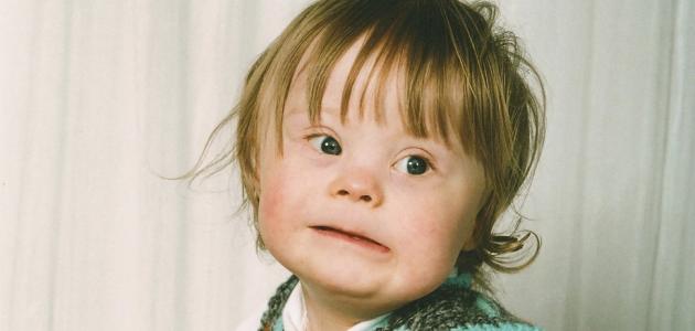 تشخيص متلازمة داون