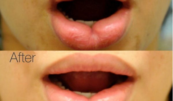 d8aad8b5d8bad98ad8b1-d8a7d984d8b4d981d8a7d98ad981 تصغير الشفايف