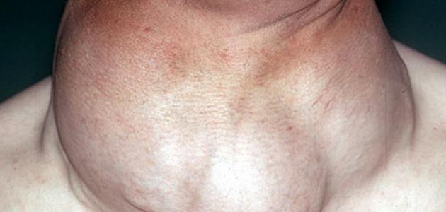 تضخم بسيط في الغدة الدرقية