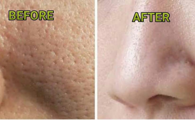 d8aad8b6d98ad98ad982-d8a7d984d985d8b3d8a7d985-825x510-2 تضييق المسام