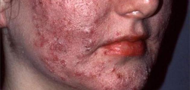 تعريف مرض الأسقربوط