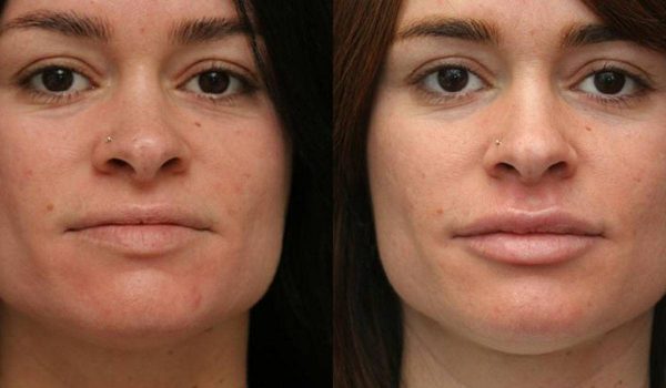 تكبير الشفايف قبل وبعد