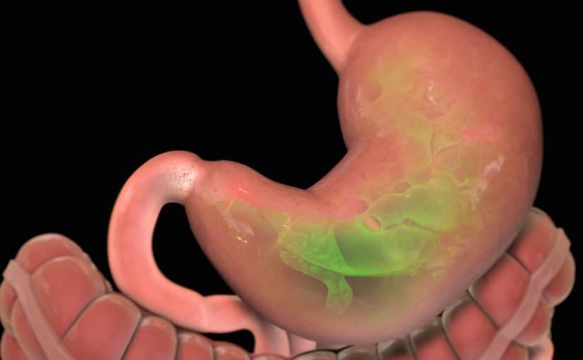 d8aad983d984d981d8a9-d8b9d985d984d98ad8a9-d8a7d984d8aad983d985d98ad985-d981d98a-d8acd8afd8a9-825x510-2 تكلفة عملية التكميم في جدة