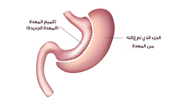 تكميم المعدة