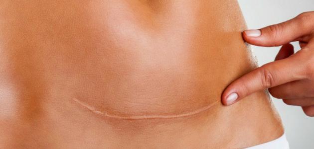 تورم جرح العملية القيصرية