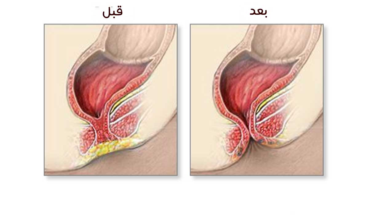 توسيع فتحة الشرج عند حديثي الولادة