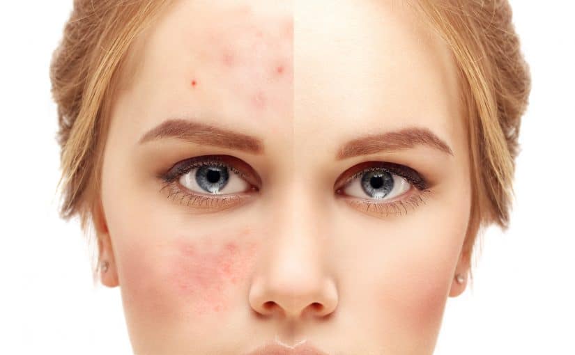 d8add8a8d988d8a8-d8aad8b4d8b1d8a8-d984d8a7d8b2d8a7d984d8a9-d8a7d8abd8a7d8b1-d8a7d984d8add8a8d988d8a8-825x510-2 حبوب تشرب لازالة اثار الحبوب