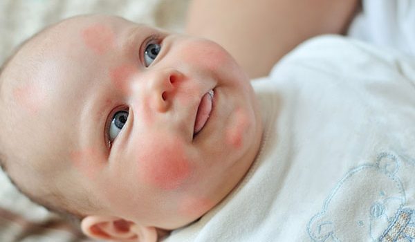 حساسية-بروتين-حليب-البقر-عند-الرضع