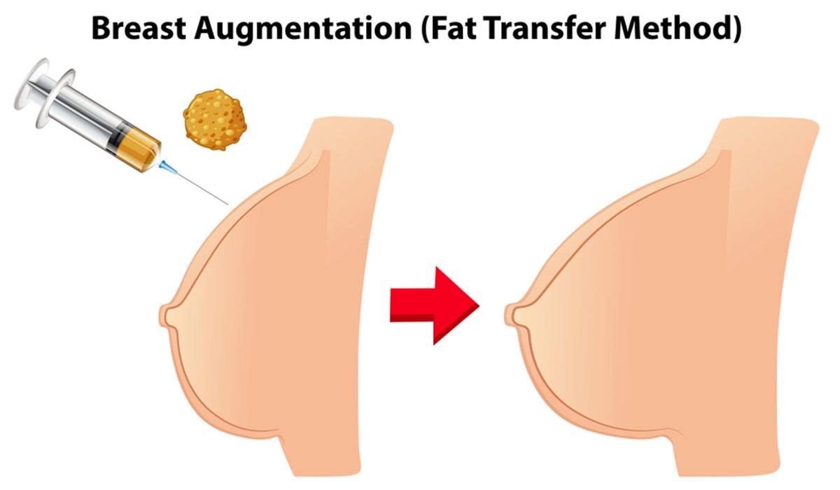 d8add982d986-d8a7d984d8afd987d988d986-d8a7d984d8b0d8a7d8aad98ad8a9-d981d98a-d8a7d984d8abd8afd98a حقن الدهون في الثدي