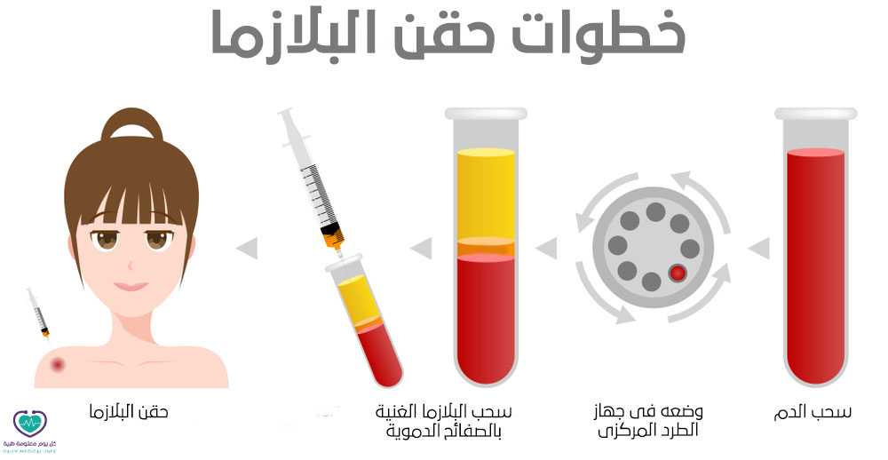 خطوات حقن البلازما