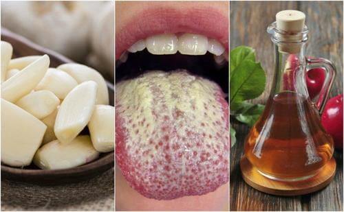 غسول فم لعلاج داء المبيضات الفموي