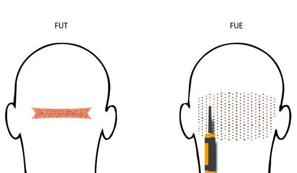 زراعة-الشعر-بالاقتطاف-والشريحة