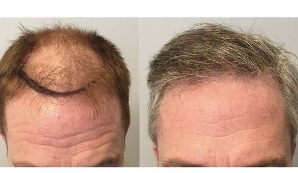 زراعة الشعر بالاقتطاف