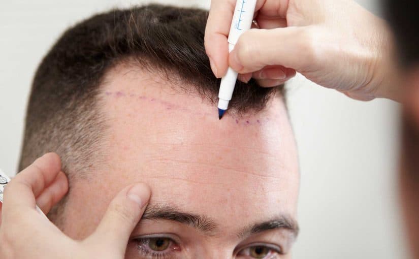 d8b2d8b1d8a7d8b9d8a9-d8a7d984d8b4d8b9d8b1-d981d98a-d8acd8afd8a91-825x510-2 تجربة زراعة الشعر في جدة