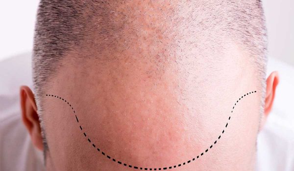 زراعة الشعر للرجال