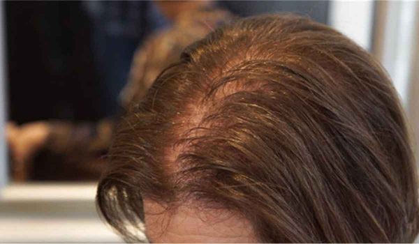 زراعة الشعر للنساء