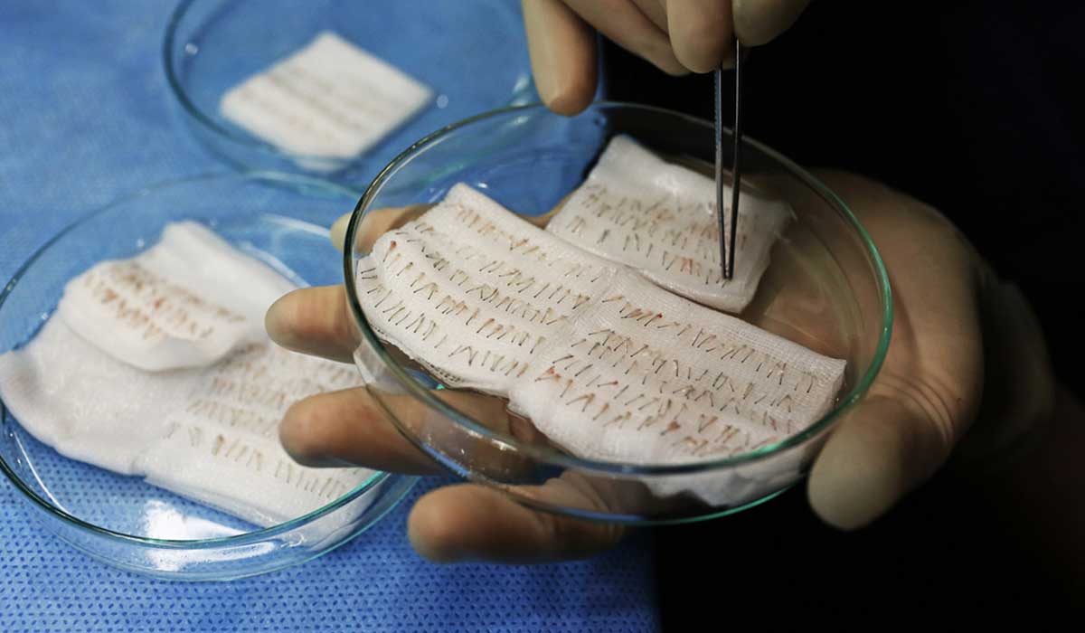 d8b2d8b1d8a7d8b9d8a9-d8a7d984d8b4d8b9d8b1-d985d986-d8b4d8aed8b5-d8a7d8aed8b1 زراعة الشعر من شخص اخر