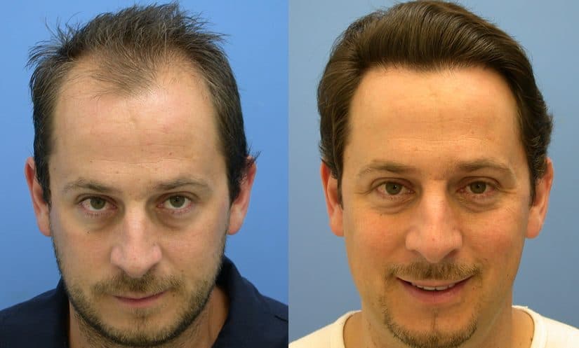 d8b2d8b1d8b9-d8a7d984d8b4d8b9d8b1-825x497-2 زرع الشعر