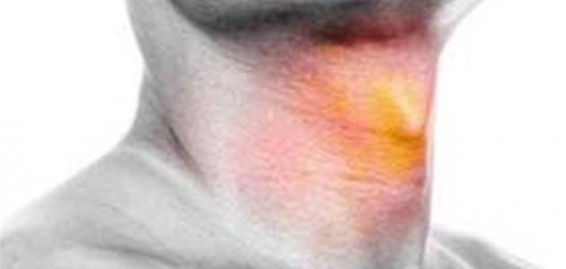 سرطان الحنجرة