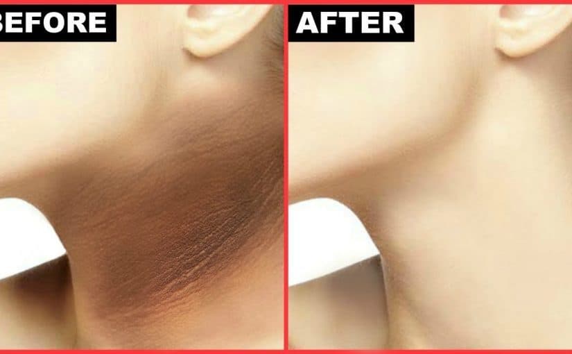 d8b3d988d8a7d8af-d8a7d984d8b1d982d8a8d8a9-d985d986-d8a7d984d8aed984d981-825x510-2 سواد الرقبة من الخلف