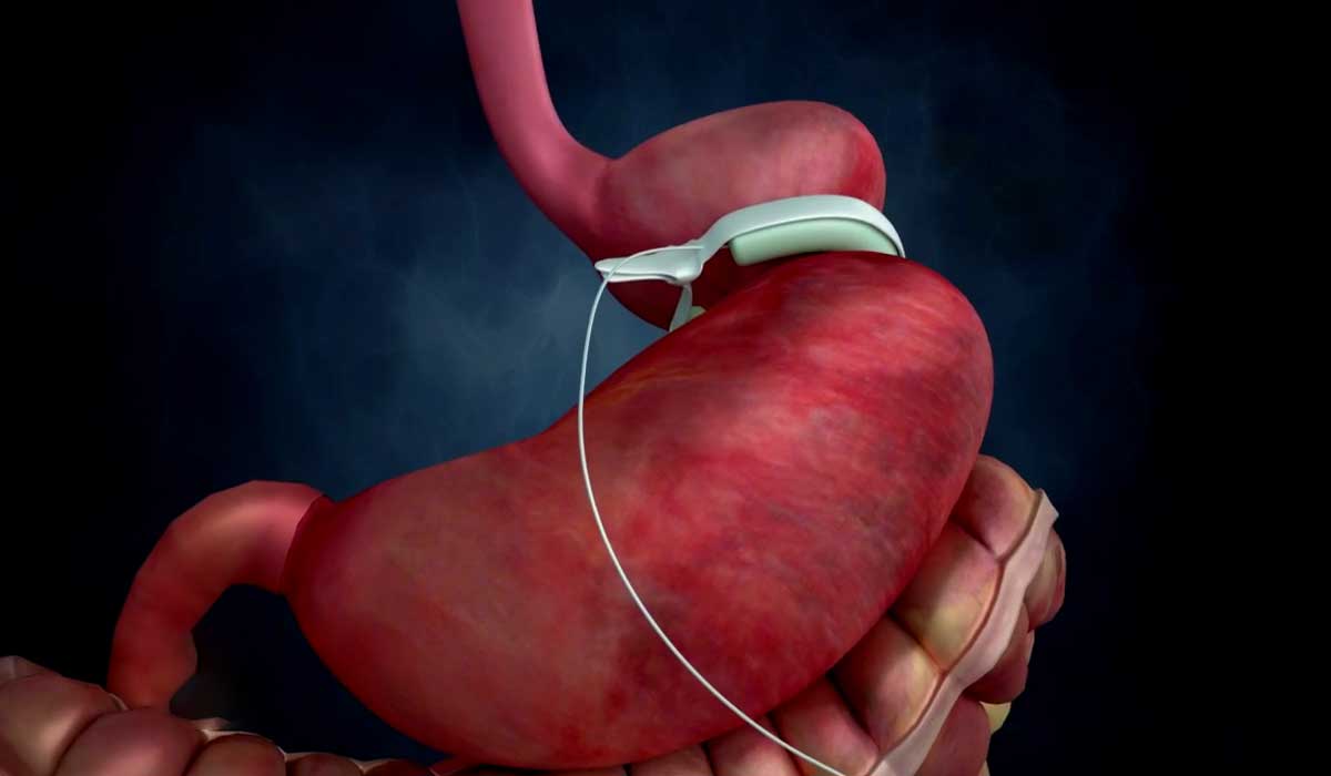 عملية ربط المعدة