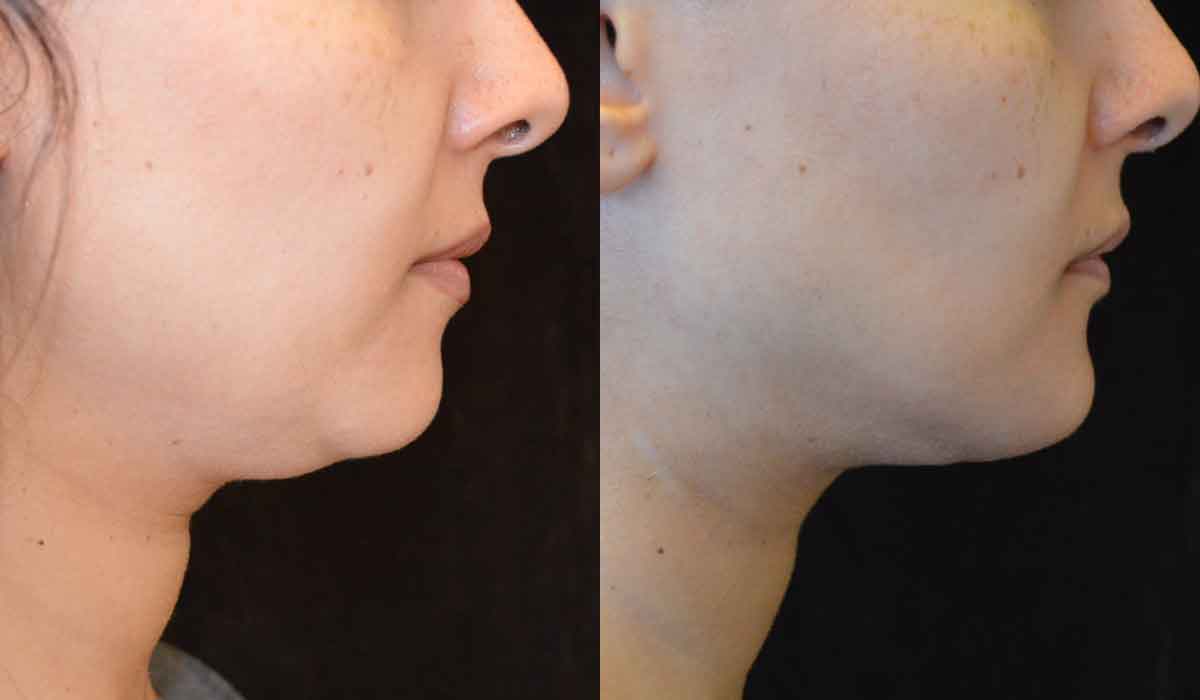 شفط دهون الوجه قبل وبعد