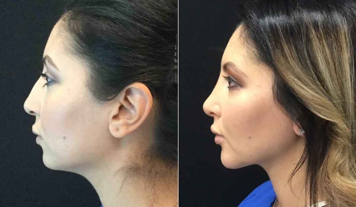 شفط-دهون-الوجه-قبل-وبعد1