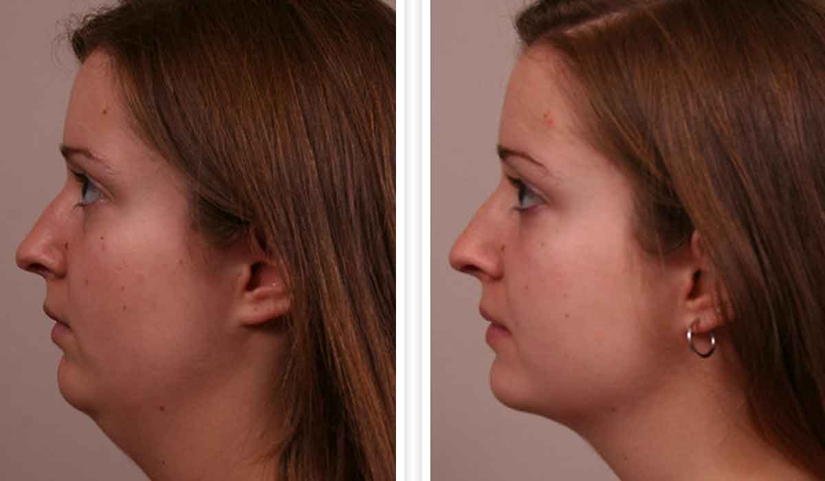 شفط-دهون-الوجه-قبل-وبعد2